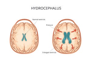 Hydrocephalus brain images