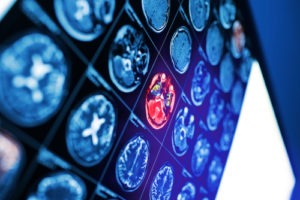 Infant Bleeding of the Brain | Birth Injury Lawyers Group Infant Brain Bleeding Lawyer