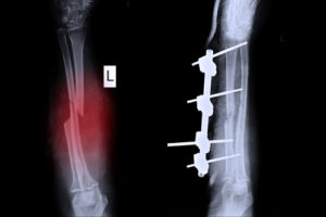Infant Broken Bones Lawyers | Birth Injury Lawyers Group Infant Broken Bones Lawyer