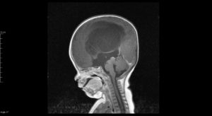 Can Hydrocephalus Be Treated?
