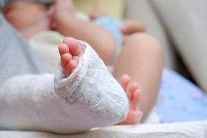 baby leg in cast after birth injury