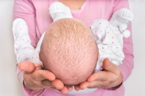 Little-newborn-baby-with-psoriasis-or-dandruff-in-the-hair