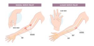 These are examples of the kinds of palsy that can happen with a brachial plexus injury. If your infant has brachial plexus damage, call us for a consultation.