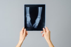 Did a doctor break your infant’s bones? Seek help from our infant broken bones attorneys at Birth Injury Lawyers Group. We have lawyers in Mesa, AZ.