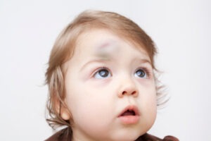 An infant shouldn’t be born with a bump like this. Get answers about what happened. Contact our Maryland infant cephalohematoma lawyers.