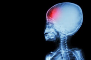 X-ray of a child’s skull fracture. Medical negligence is a common cause of infant skull fractures.