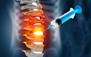A three-dimensional illustration of an epidural injection, leaving patients to wonder about the signs of nerve damage caused by an epidural.