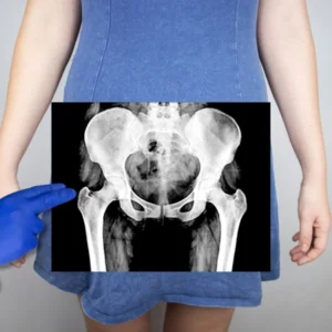X-ray of the pelvic bones of a woman. How common is tailbone injury during childbirth?
